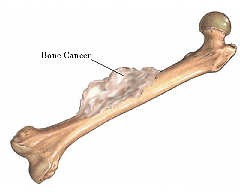 Bone Cancer
