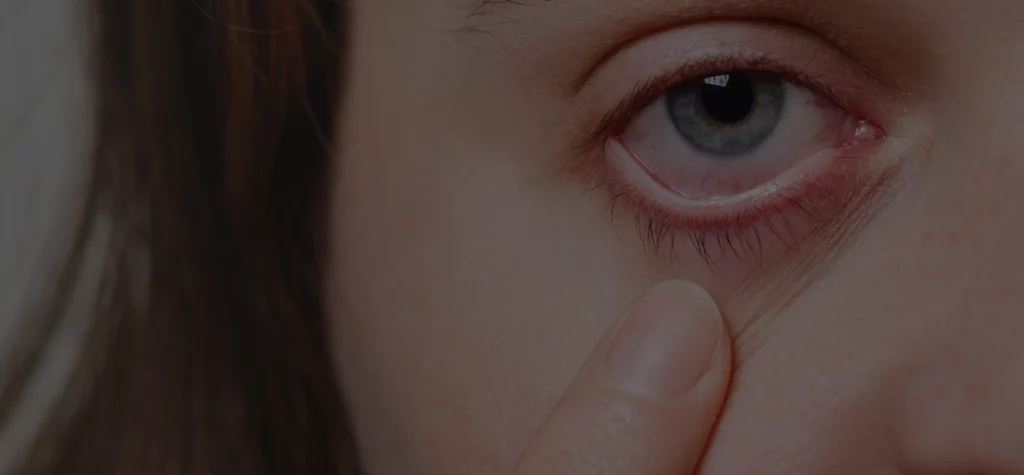Can Pink Eye Be Diagnosed Virtually
