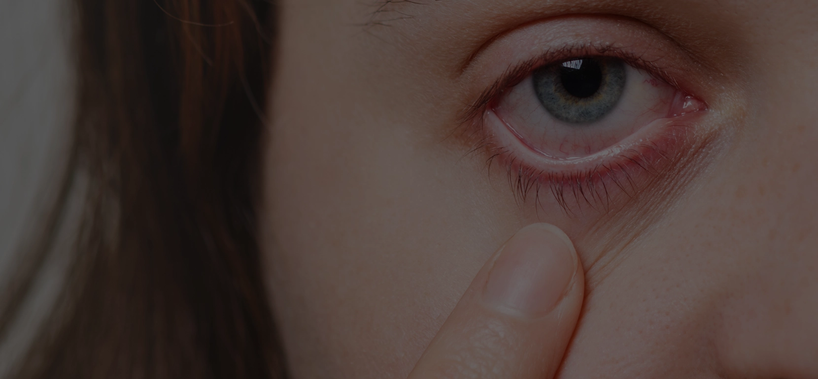 Can Pink Eye Be Diagnosed Virtually? What You Need to Know